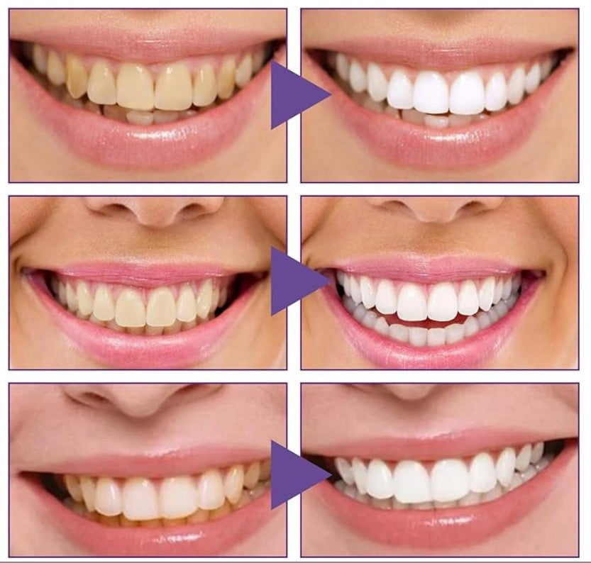 OUHOE V34 – Коректор за избелување на забите